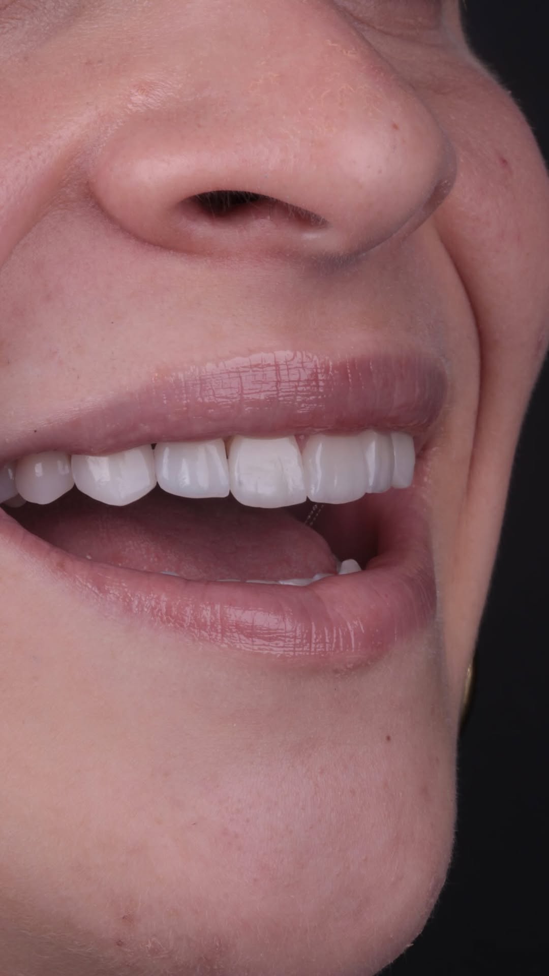 Harmonização Facial em São Paulo: O Caminho para um Sorriso Impecável